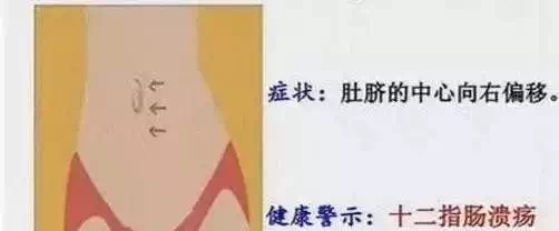 你的肚脐，出现这种特征，说明你的身体超健康