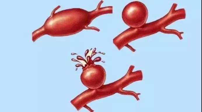 关于“脑梗”，您有必要知道的救命常识