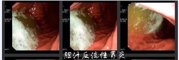 胆汁反流性胃炎这么做就能治好，包括药疗和食疗