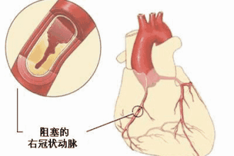 冠心病患者血压低，这几种原因要注意！