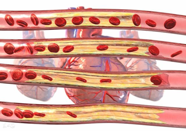 皮肤上有这4种表现，就是动脉硬化向你“报到”！