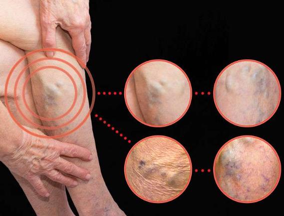 腿部出现5个现象，说明血管动脉硬化严重，不想双腿报废就看过来