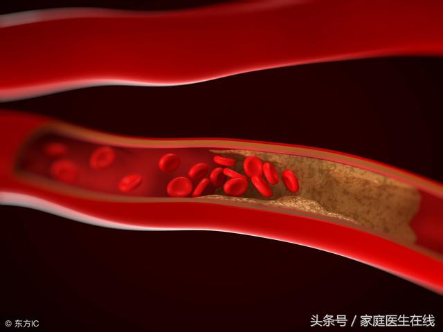 防动脉硬化的5种食物，天天换着吃，让你血管远离硬化