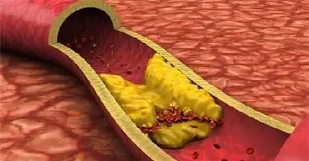 动脉硬化不要怕，我们早有好办法