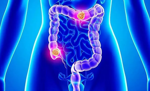 病从口入，盘点“吃”出来的癌症