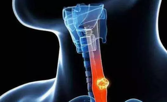 病从口入，盘点“吃”出来的癌症