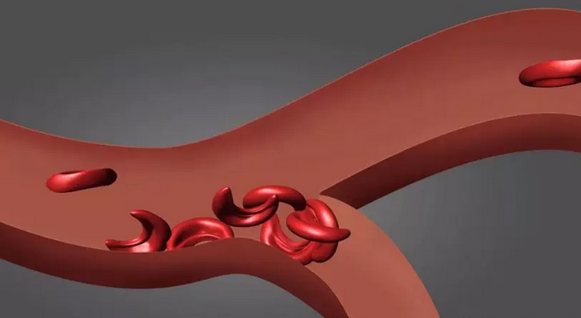 NIH院长谈干细胞基因治疗首例镰状贫血症