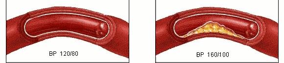 血压压差大，脑梗心梗找上门！这3样食物坚持吃，血管通畅血压降