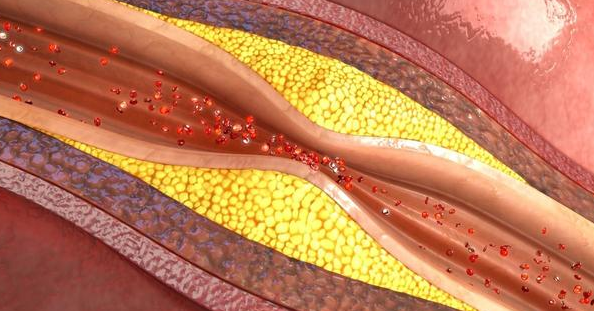 血压压差大，脑梗心梗找上门！这3样食物坚持吃，血管通畅血压降