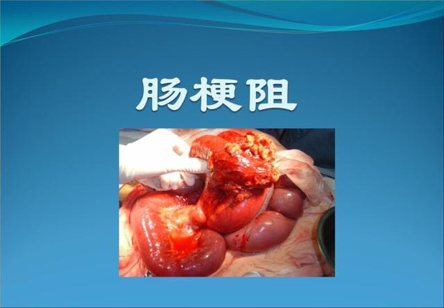 肠梗阻就极有可能是藏在背后的健康隐患