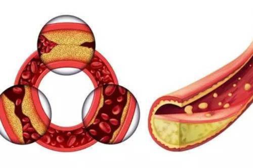 怎么降低胆固醇减少心脑血管病？研究发现这种食物蛋白有效。