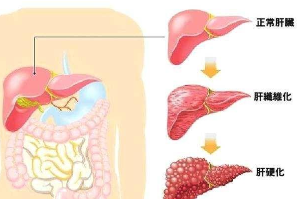 肝硬化，饮食要注意哪些？