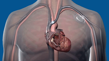 什么样的运动对心脏才真正有益？