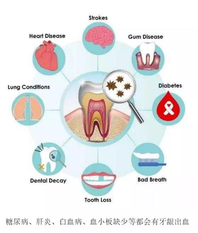 牙病会致癌！有这些症状的人，一定要小心