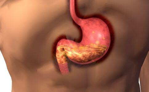 腹胀、打嗝、呕吐竟是胃病在“作怪”