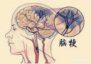 身体的哪些症状是轻度脑梗的信号？