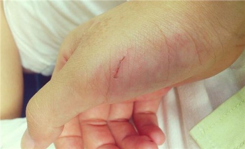 6个信号证明你有糖尿病，有3个以上需及时治疗